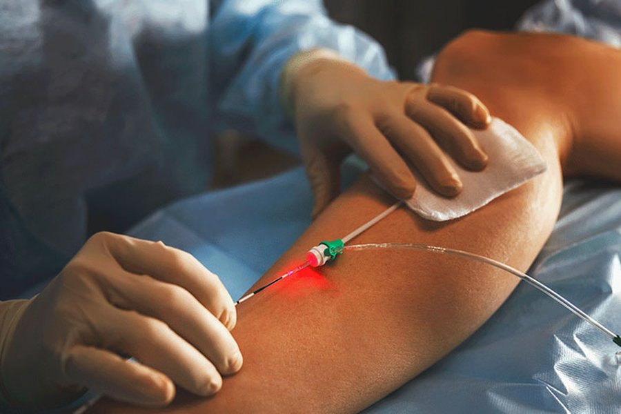 Cirurgia de varizes com laser