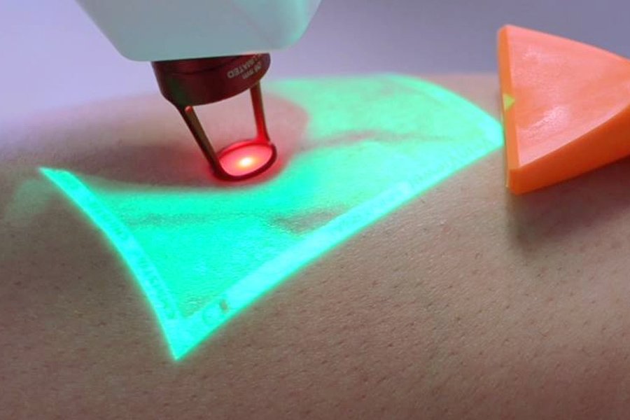 ClaCs: laser e escleroterapia