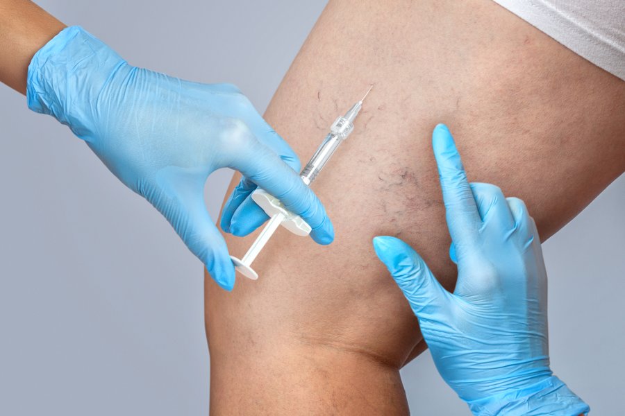 Escleroterapia