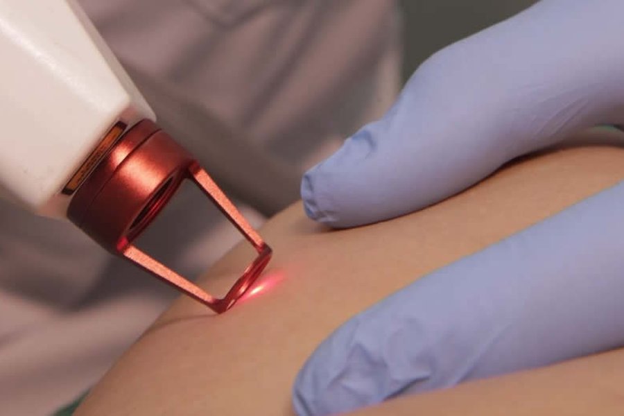 Laser transdérmico