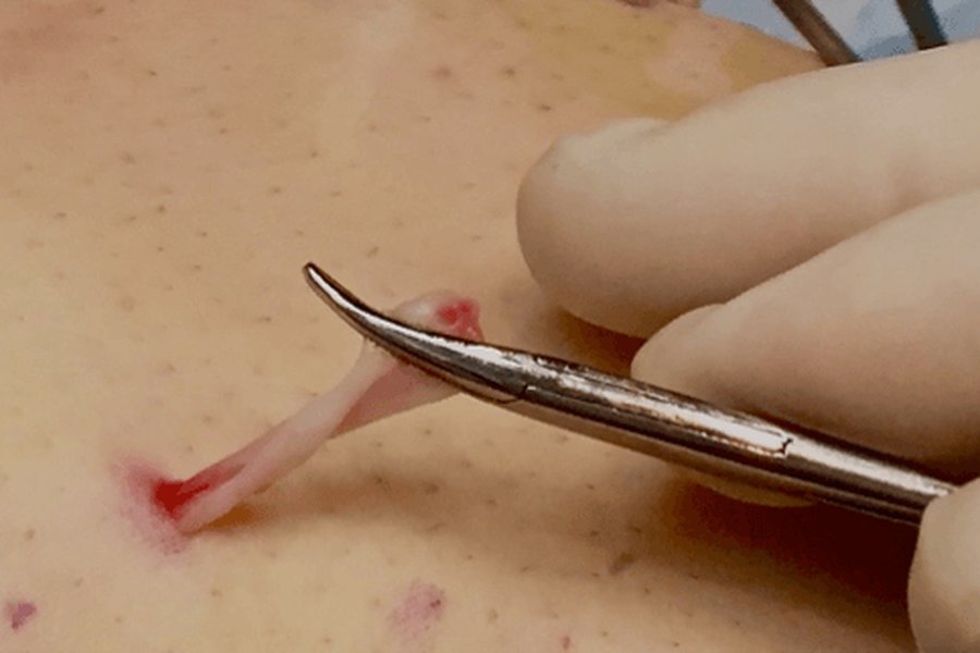 Microcirurgia de varizes